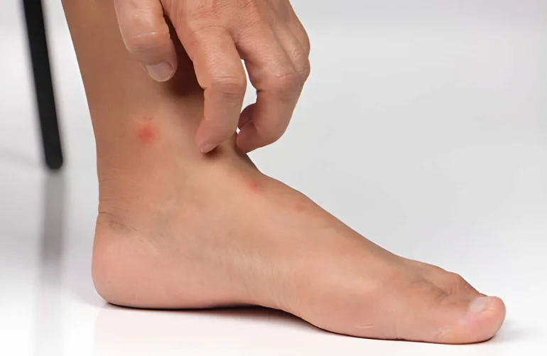 Understanding Allergic Reactions to Bed Bug Bites: Symptoms & Tips